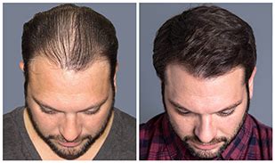 Bosley hair transplant - Your recovery process will depend on the type of transplant you have. In the days after surgery, you may be able to: Day 1: Remove bandages. Day 2: Wash your hair. Days 3 to 5: Return to work and start light activities. After 10 days: Remove stitches (done by your healthcare provider).